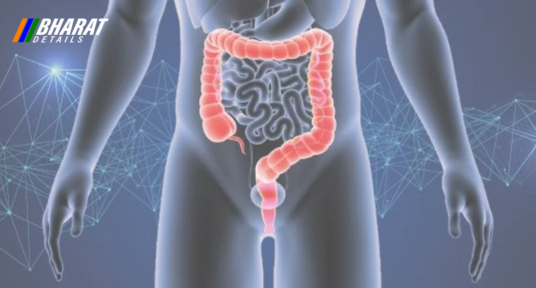 Colorectal Cancer