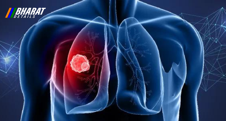Lung Cancer