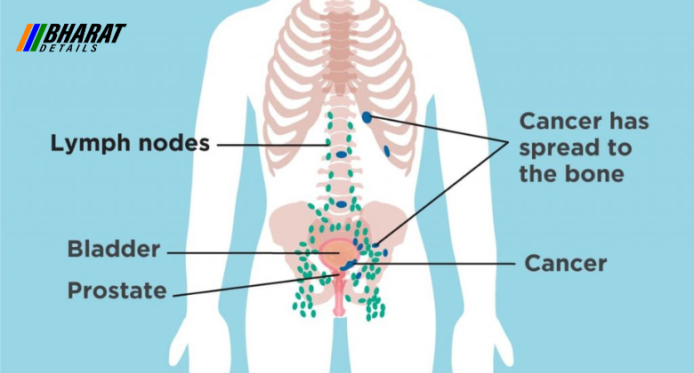 Prostate Cancer