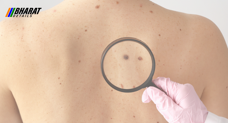 Skin Cancer